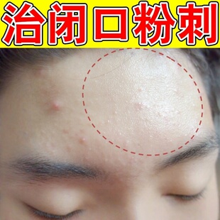逆光疹修复脸上起小疙瘩闭口粉刺的痘腿上有鸡皮祛清肤霜痘