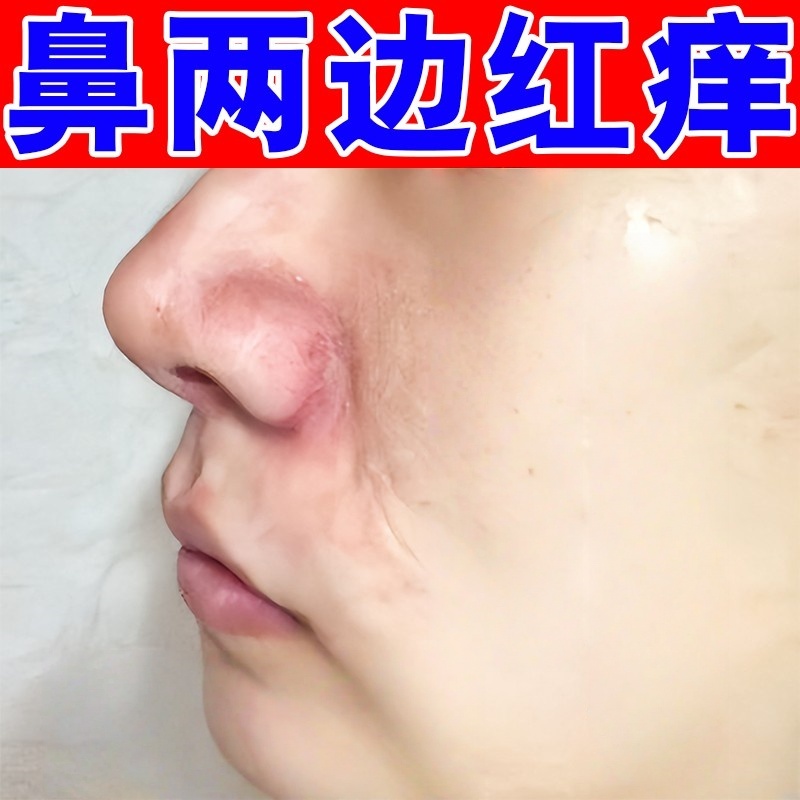 鼻子两侧发红脱皮鼻翼两边泛红干燥起皮酒糟鼻皮焱红血丝干裂疼痛