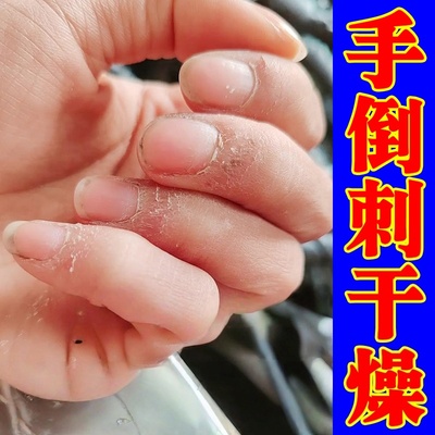 手指倒刺营养油修复边缘干燥开裂起硬皮脱皮粗糙裂口去死皮护手霜