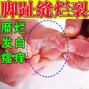 脚趾缝分离烂脚脚皮糜烂脚趾缝烂痒溃烂发白开裂口抑膏气菌脱