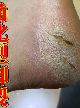 鳞屑角化型脚感染真菌脚后跟开裂角质层增厚去死皮老茧抑软膏菌气