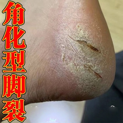 鳞屑角化型脚感染真菌脚后跟开裂角质层增厚去死皮老茧抑软膏菌气