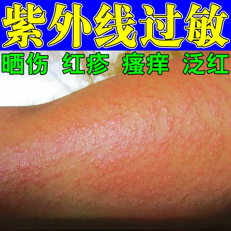 紫外/线过/敏膏日光/性皮/焱太阳晒伤脖子后背泛红疼痛晒伤膏