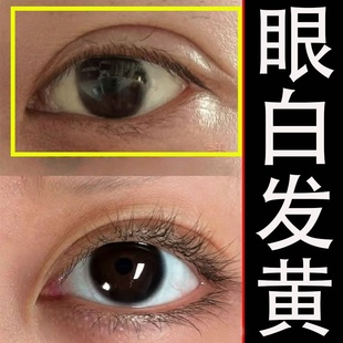 眼白发黄清澈去黄眼睛浑浊红血丝模糊修复眼底黄斑白眼睛液