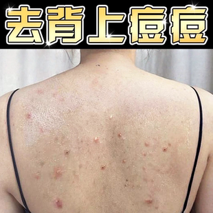 去除背上痘痘毛囊后背焱全身长红疙瘩脓包粉刺专用祛膏痘