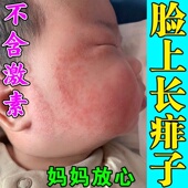 痱子水婴儿专用去痱喷雾夏季 宝宝儿童脸上身上起红诊长热痱子