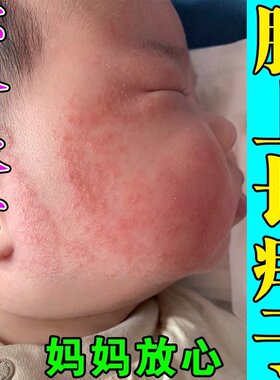 痱子水婴儿专用去痱喷雾夏季宝宝儿童脸上身上长热痱子