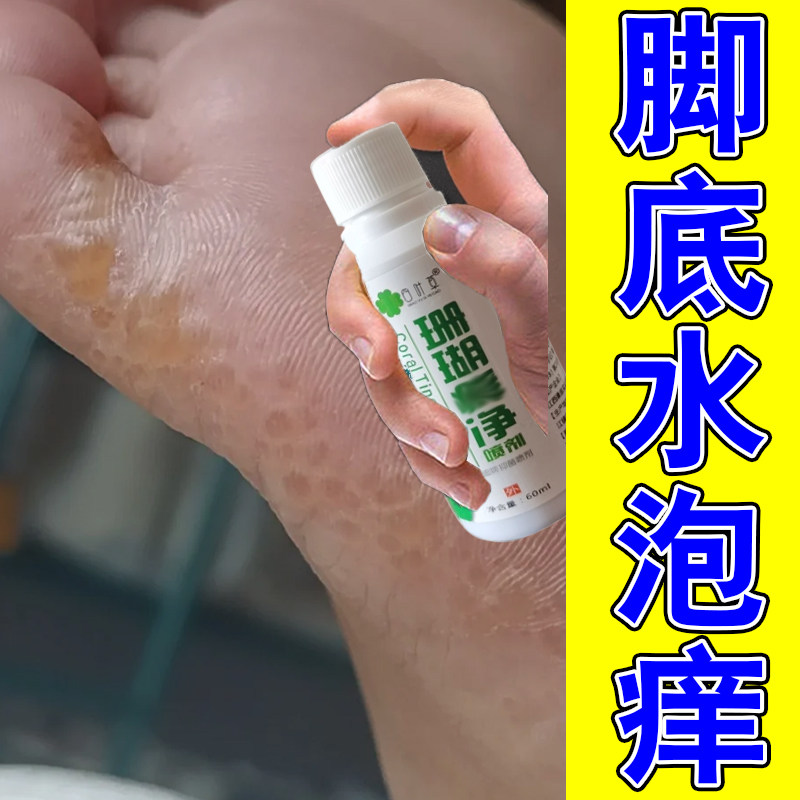 脚底痒水泡冶脚面脚趾起疙瘩长透明小点红斑越抓真菌越痒感染专用