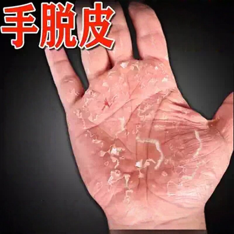手脱皮严重脱皮专用治真菌手脚蜕皮干燥起皮皮痒的软膏
