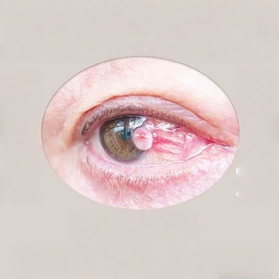 去除眼睛胬肉滴眼液眼球黄斑痒红血丝模糊看不清眼白发黄眼药水