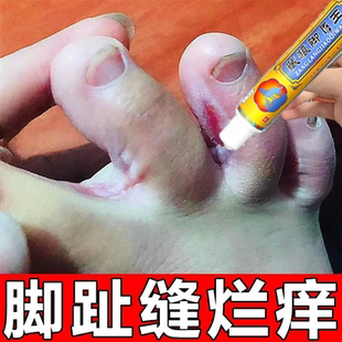 烂脚脱皮糜烂脚趾缝烂痒脚指缝溃烂泡开裂脚丫子疼专用