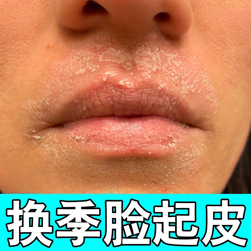 脸皮肤干燥起皮脸上爆干皮有碎屑起鲜红痒脱皮过敏下巴掉皮屑补水
