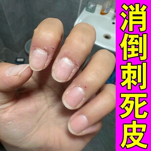 手指倒刺修复营养油儿童成人手上干燥脱皮干裂起硬皮粗糙肉刺
