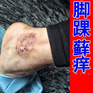 脚踝痒脚脖子发痒脚部痒真菌脚面痒踝关节起红疙瘩红斑痒