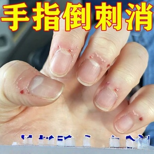 手指起倒刺修复受损倒刺营养油去刺神器防儿童手上边缘干裂脱皮膏