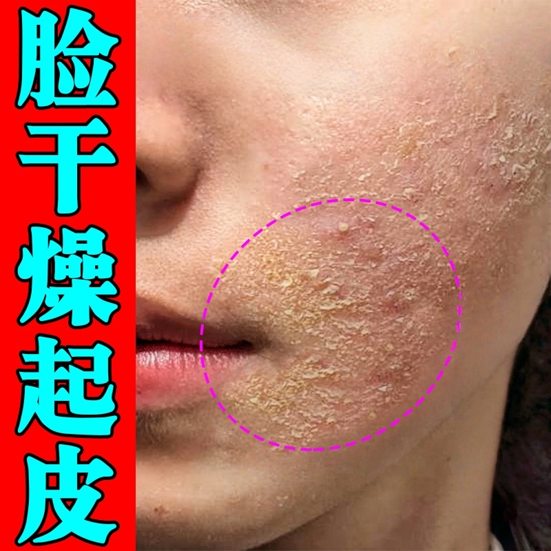 脸干燥起皮有碎屑修复滋润霜换季脸部爆干皮脱皮掉皮发痒皮肤粗糙