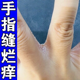 烂手丫专用软膏手指缝溃烂痒脱皮经常碰水指缝开裂糜烂痒膏