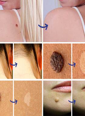 Warts Remover Liquid Antibacterial Ointment Wart Treatment C