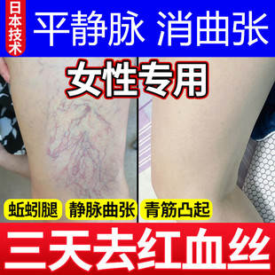 女性腿上有红血丝去除凝胶修复毛细血管扩张医用静脉曲张保护剂