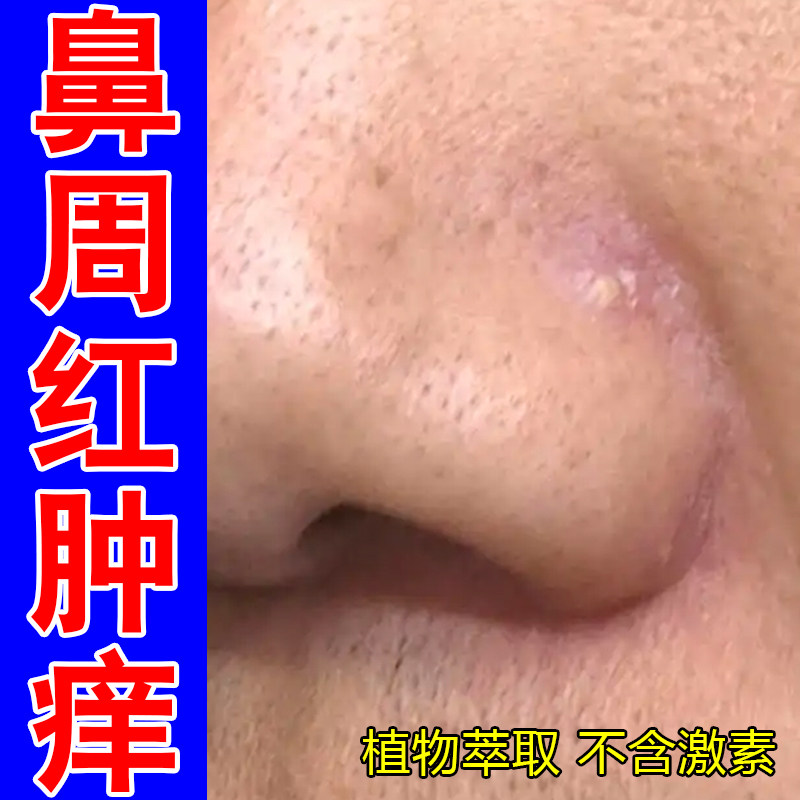 鼻周红肿痒起皮掉屑换季过敏男女通用鼻子痒脱皮长红疙瘩修护药乳
