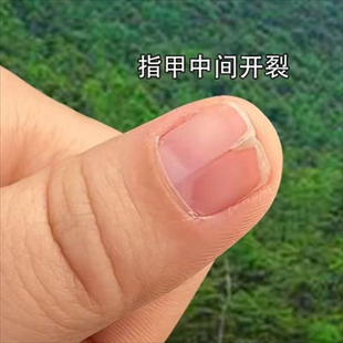 指甲盖中间竖纹裂开指甲有竖纹指甲表面凸起凹凸不平指甲防裂修复