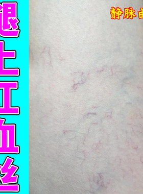 专用膏腿脚上有红血丝男女下肢血管堵塞肿胀毛细血管扩张