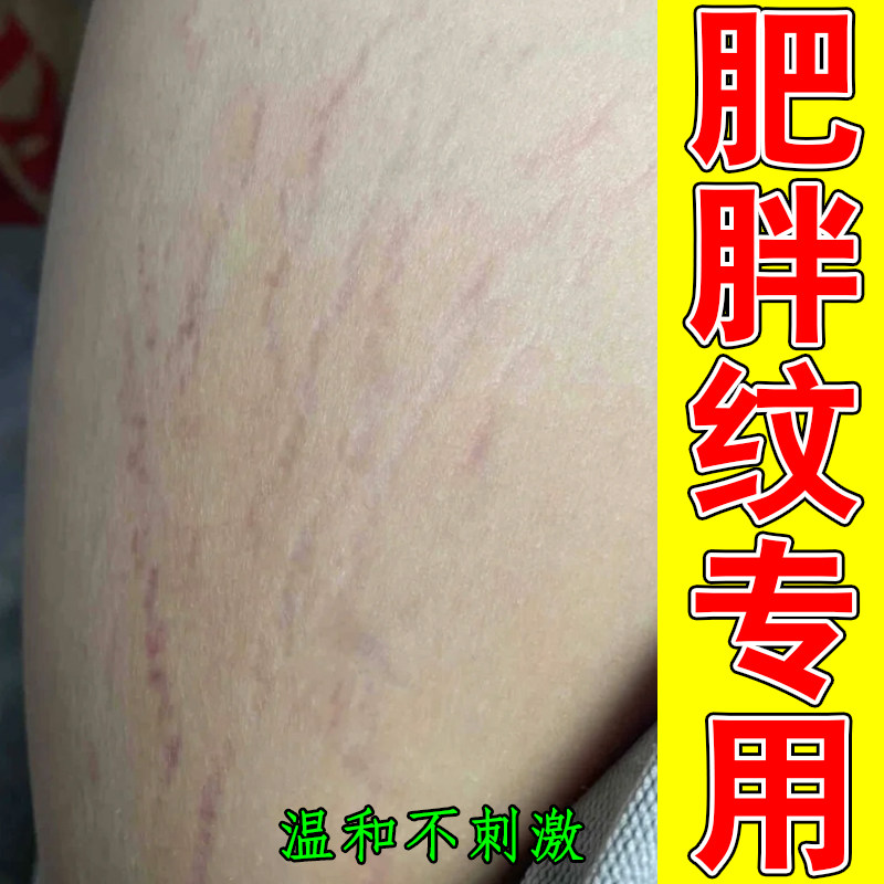 去肥胖纹修复霜生长纹消除大腿学生青少年男士淡化修复外用药乳膏