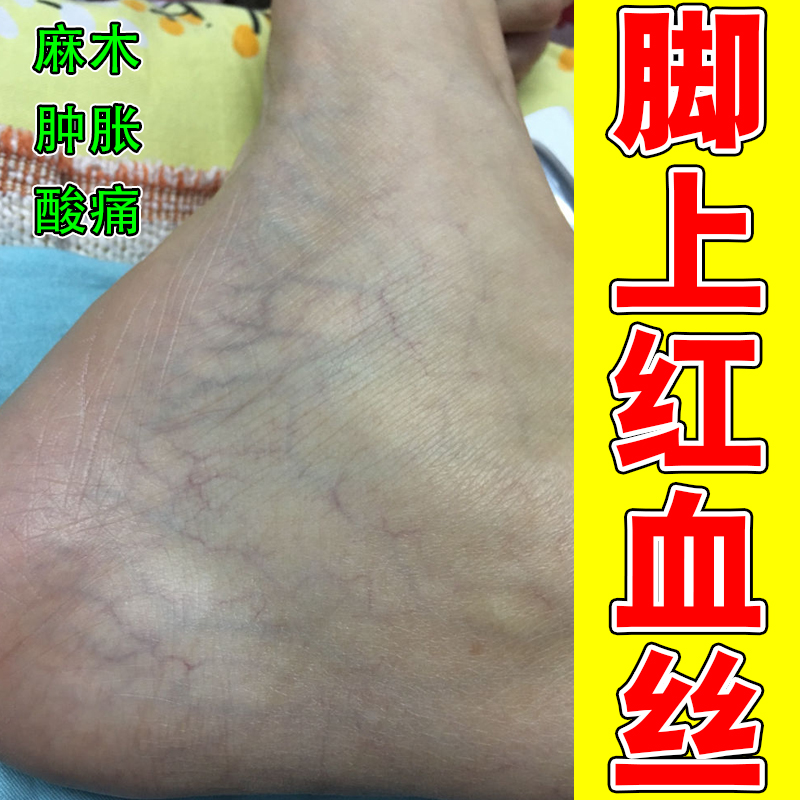 腿有红血丝静脉曲张酸麻专用药乳