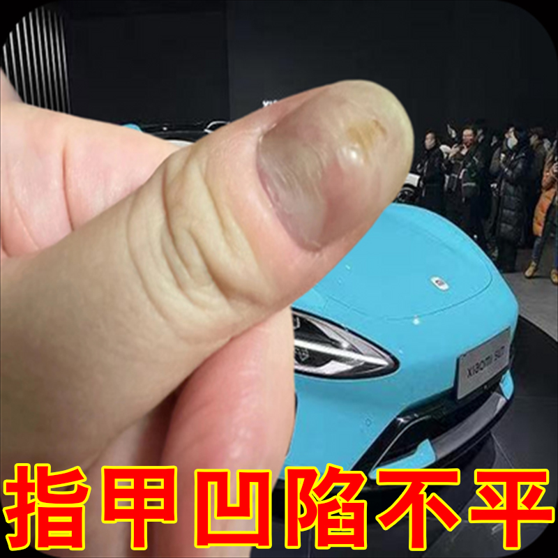 冶甲母痣指甲黑色竖纹黑线大拇指指甲里面有黑线手指甲真菌感染药