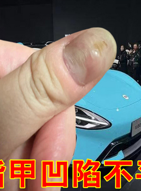 冶甲母痣指甲黑色竖纹黑线大拇指指甲里面有黑线手指甲真菌感染药