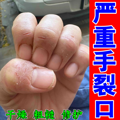 严重手裂口手脚干燥粗糙开裂出血真菌感染儿童手爆皮防皲裂专用膏