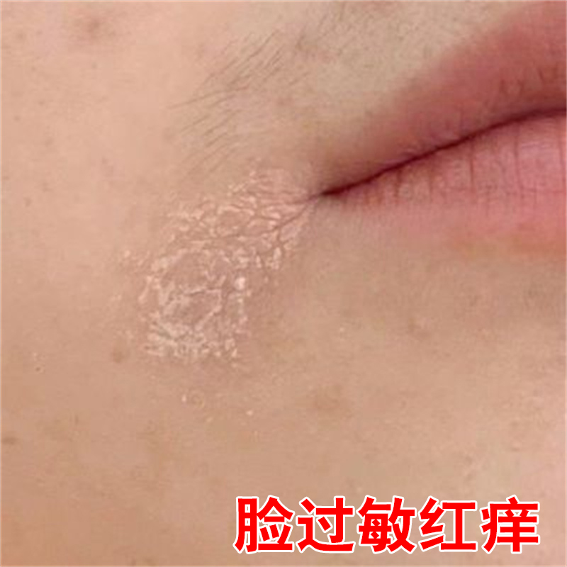 冶脸上起皮干燥脸部干燥起皮掉皮干痒面部起干皮润肤去痒脸上长痒