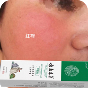 激素脸大面积泛红脸过敏红疙瘩皮肤红肿发热发痒修复过敏红血丝膏