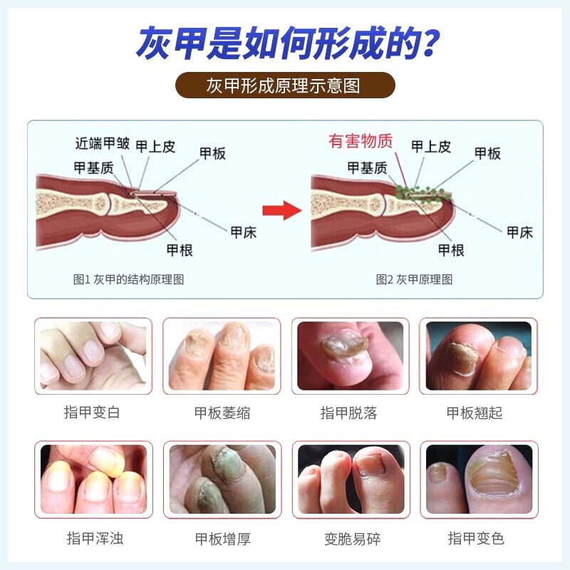 灰指甲打磨机器电动磨甲器硬脚趾甲修甲专用工具锉刀老人灰厚指甲