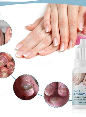 Fungus Treatment Oil Foot Repair Essence Fungus Oil Shine