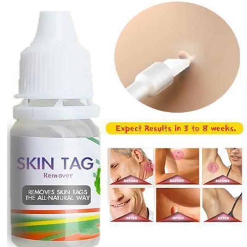 10ml Skin Tag Remover Wart Treatment Papillomas Removal Liqu