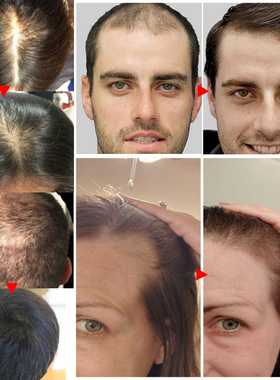 好货Ginger Hair Growth Spray Products Natural Anti Hair Loss