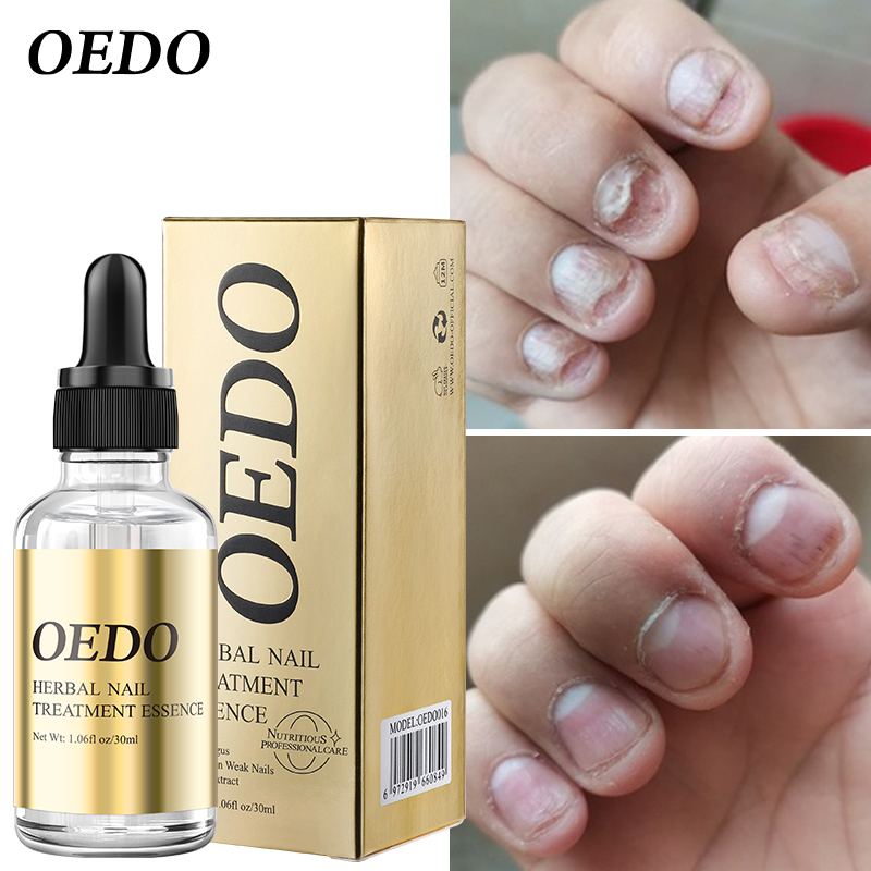 Fungal Nail Treatment Essential Oil Hand and Foot Whitening