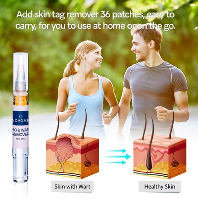 Removing Agat Moles Liquid Pen Treatment Papillomas Removal