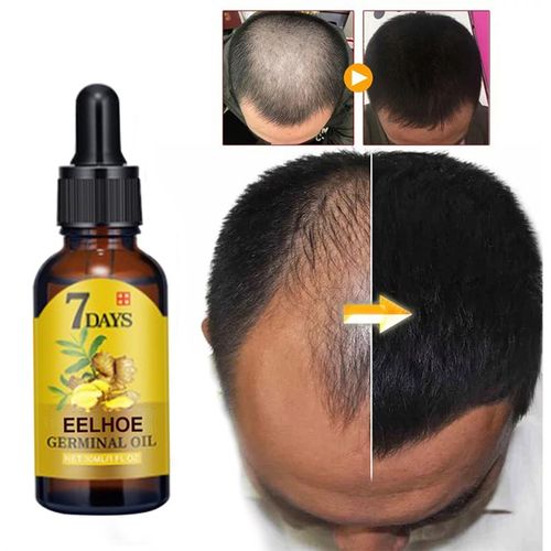 Hair Loss Treatment Ginger Growth Essence Oil老姜头发养护油