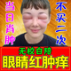 眼睛周围红肿眼皮红肿痒过敏发痒霰粒肿热敷眼贴发痒睑板腺疏通器
