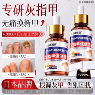 治灰指甲发黄增厚阿莫罗芬搽旗舰店专用抑菌液脚趾冰醋酸涂剂