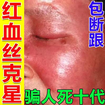 去红血丝修复角质层改善敏感肌肤增厚修复脸部泛红痒脸上干燥起皮