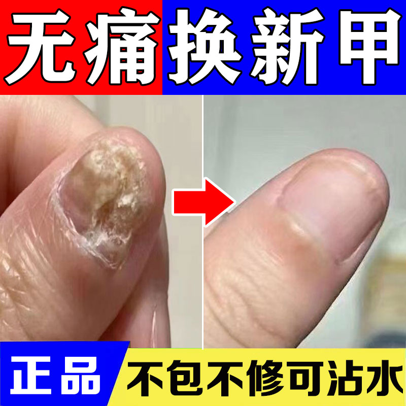灰指甲专用主攻增厚型灰趾甲脱甲