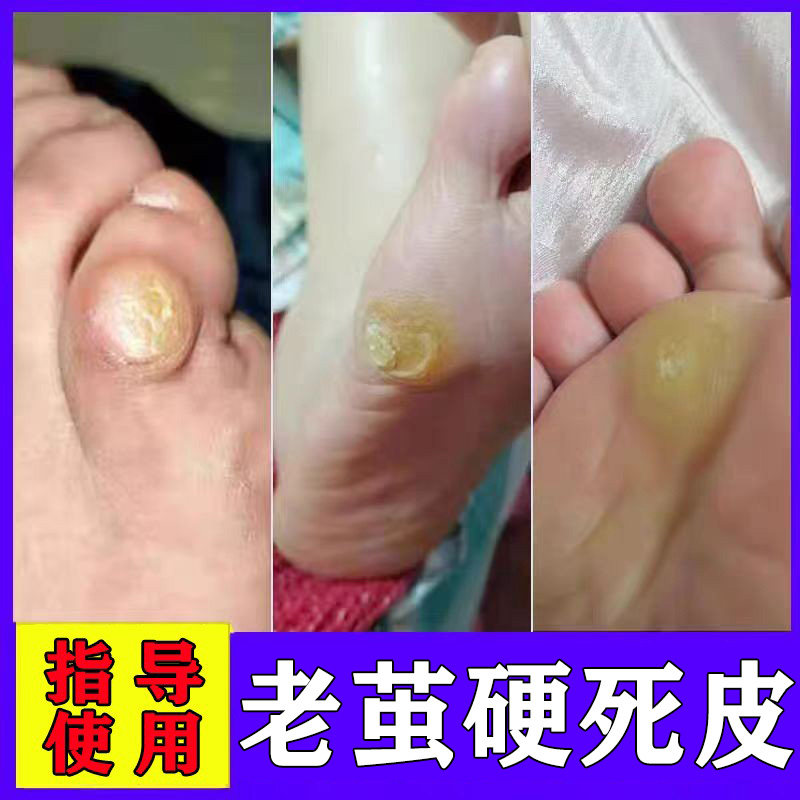 脚上有老茧手茧鸡眼膏脚底老茧软化剂脚趾头厚茧子脚垫硬死皮神器
