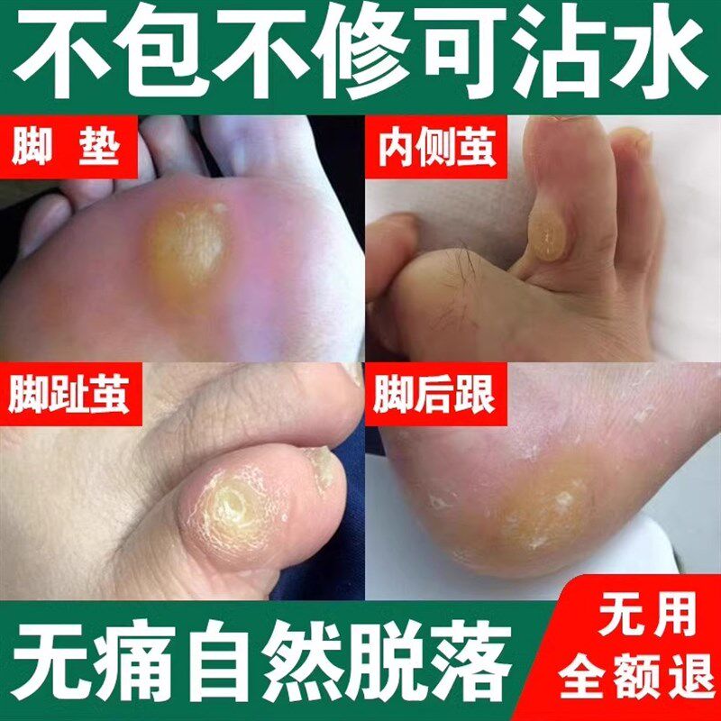 热销去除脚底老茧脚垫软化剂小脚趾头硬死皮关节茧子鸡眼脚钉祛除