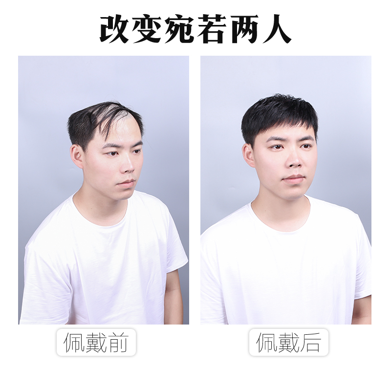 男士补发片假发套头顶补发前额秃顶补发垫接发翻盖假Y发真发男发
