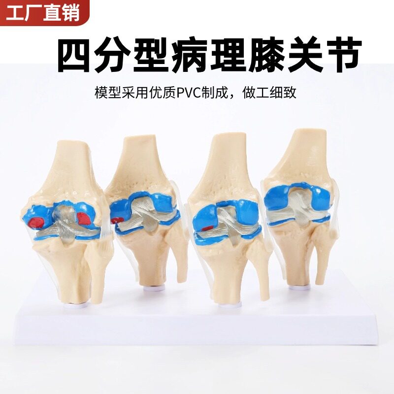 人体病态膝关节模型 四阶段病理膝关节模型 病变 人体膝关节模型