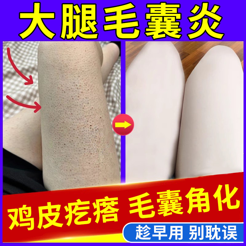 鸡皮肤疙瘩毛囊角化症专用药去除神器腿部手臂毛囊炎胳膊长疙瘩JY