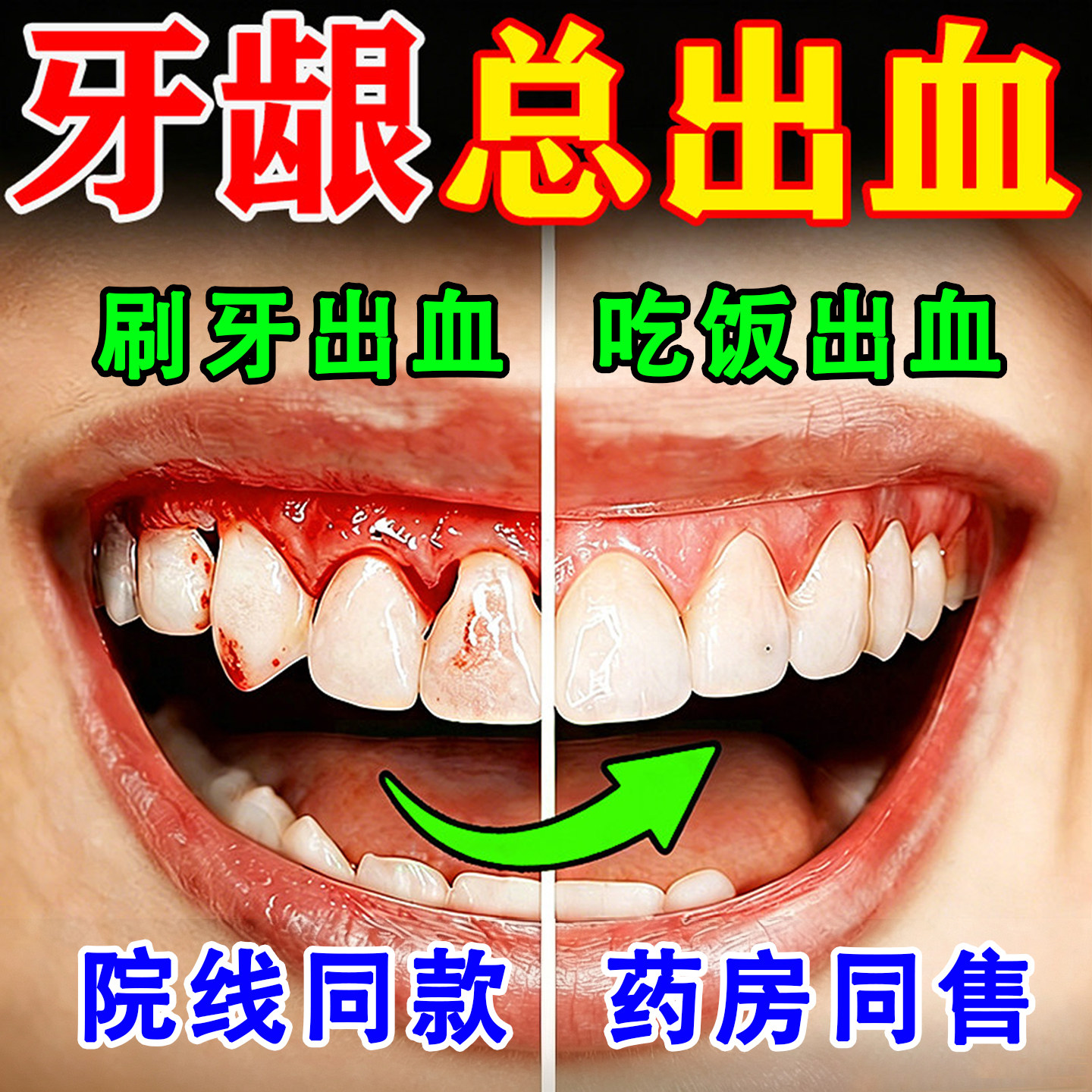云南白药牙膏牙周炎牙龈出血专用牙龈炎萎治疗医用修复防出血JN